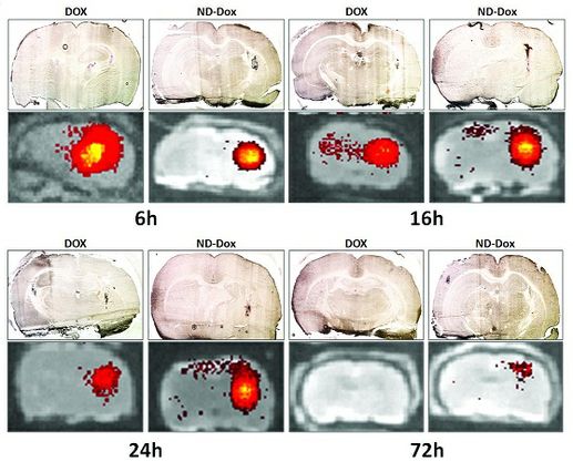 Decadron Dosage For Brain Tumor