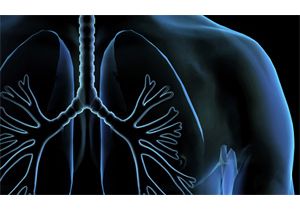 lung cancer