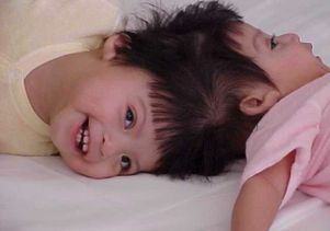 The twins were born joined at their heads before UCLA surgeons separated them in 2002.