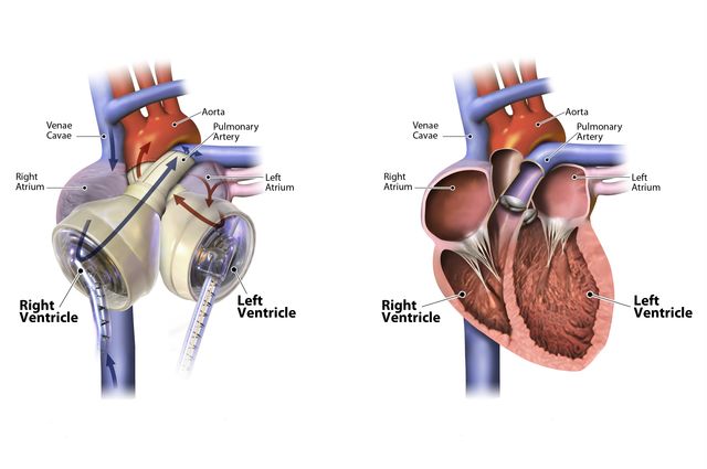 The SynCardia Total Artificial Heart, at left, and a human heart, at right.