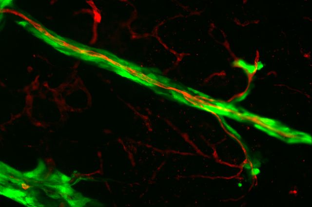 Melanoma cells spreading