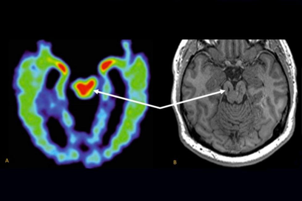 mri-scan-may-help-diagnose-chronic-traumatic-encephalopathy-ucla