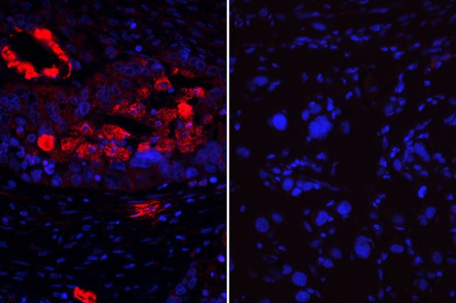 Ovarian cancer tumor cells