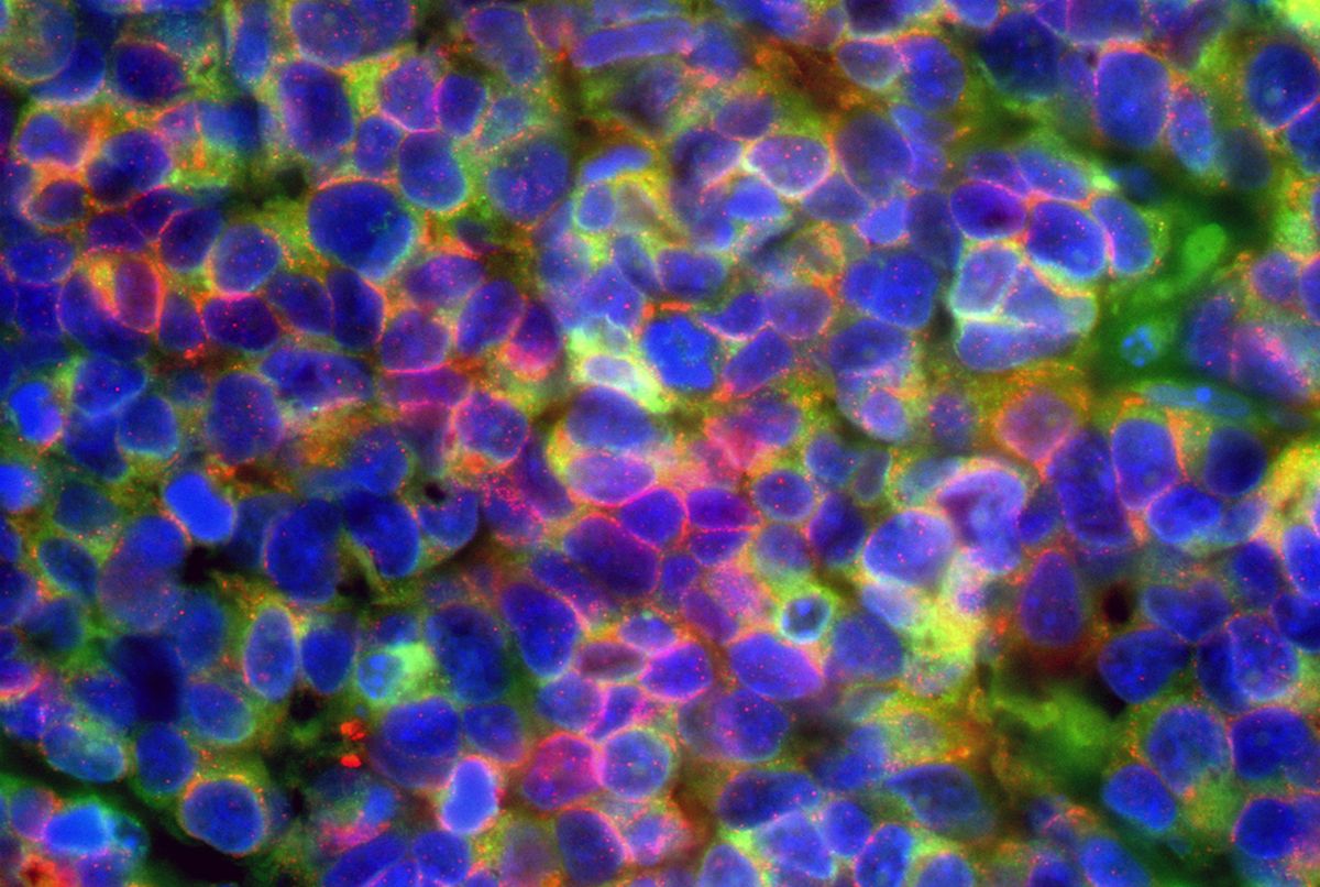 Stage 4 Lung Cancer >> UCLA researchers discover aggressive prostate and lung cancers are driven by common mechanisms ... Stage 4 Lung Cancer >> UCLA researchers discover aggressive prostate and lung cancers are driven by common mechanisms ...