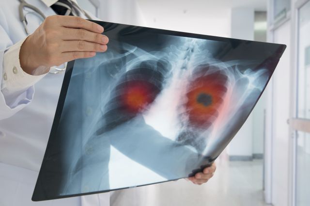 lung cancer scan