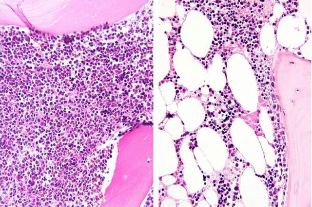 Bone marrow before and after chemotherapy