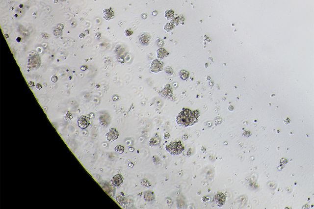 Ovarian cancer tumor organoids