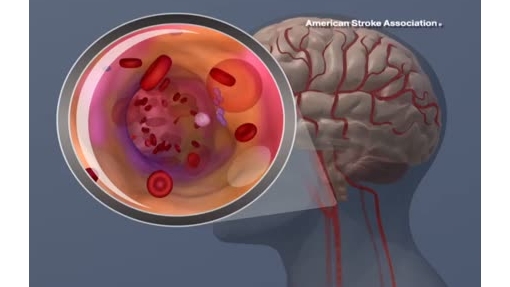 Ischemic Stroke Animation