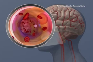 Ischemic Stroke Animation